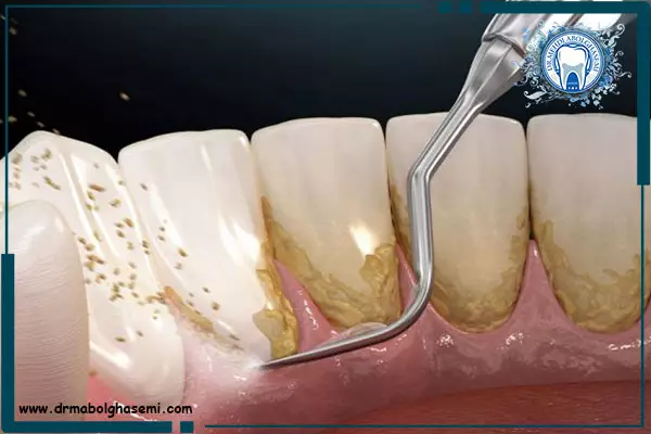 دلایل ایجاد جرم بر روی دندان