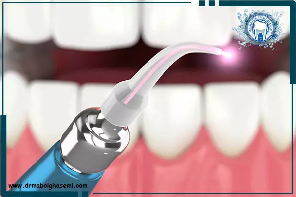جرم گیری یا بروساژ دندان با لیزر