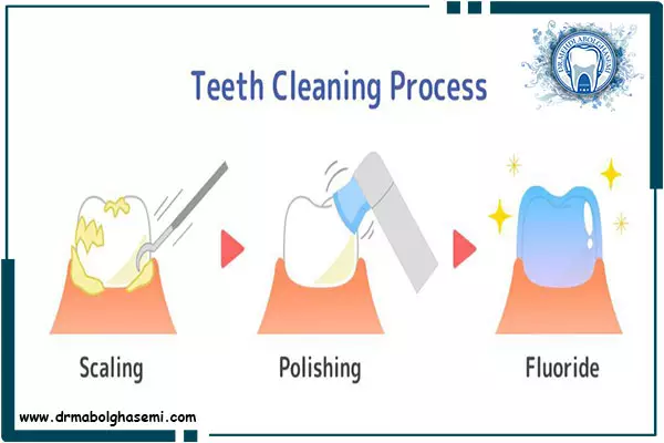 مراحل جرم گیری یا بروساژ دندان