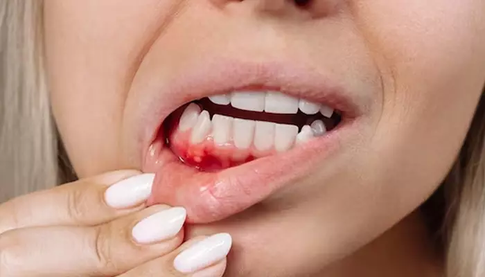 بیماری های لثه و علت بوی بد دهان