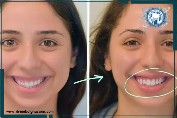 لیفت لثه قبل و بعد