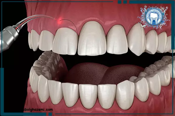 لیفت لثه با لیزر