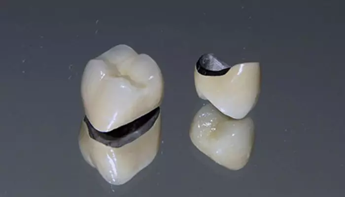 روکش سرامیکی فلزی