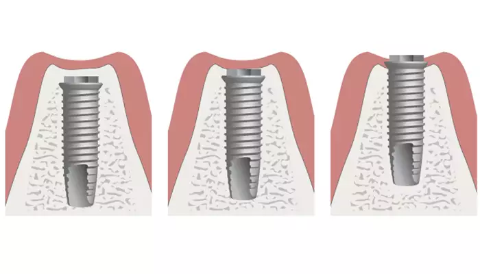 کاشت فیکسچر یا پست  از مراحل ایمپلنت دندان