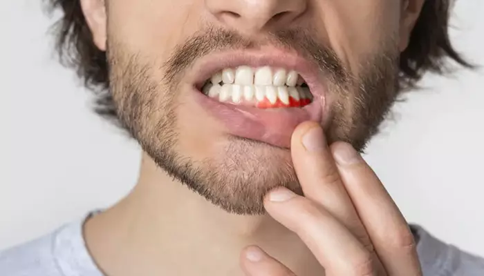 عوارض جرمگیری دندان