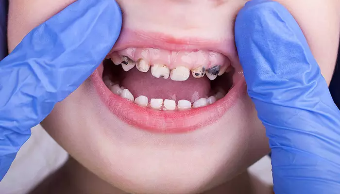 تصویری از پوسیدگی دندان