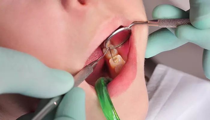 علت پوسیدگی دندان کودکان