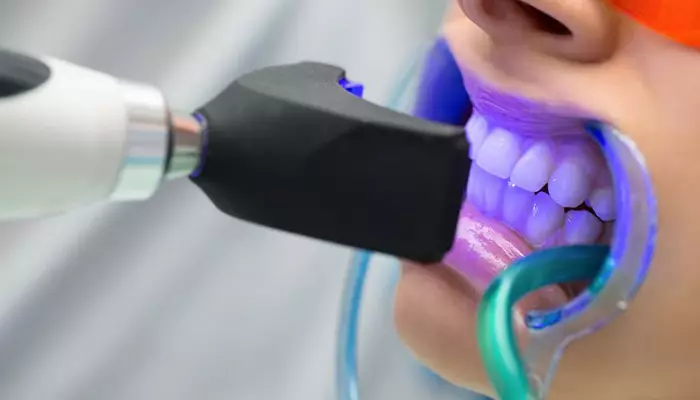 تفاوت جرم گیری و بلیچینگ دندان