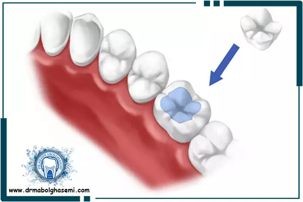 ترمیم دندان شکسته