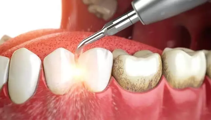 اولتراسونیک جرمگیری دندان