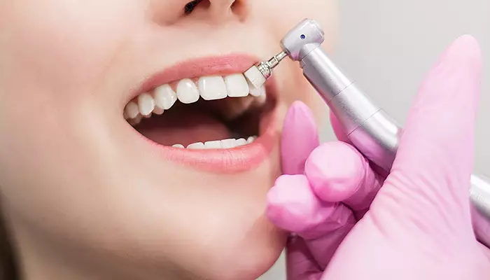 جرم گیری دندان چیست