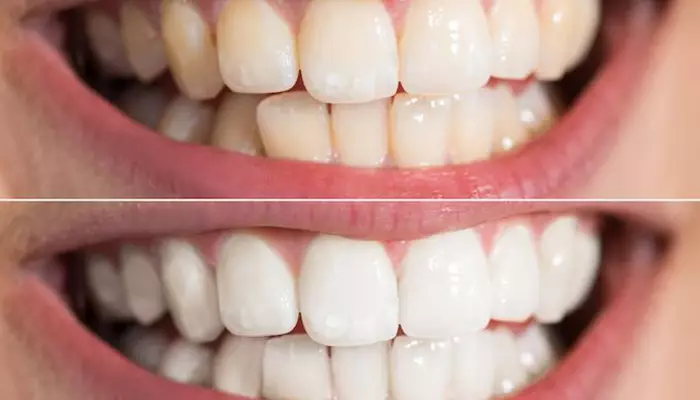 انواع لیزر برای سفید کردن دندان با لیزر