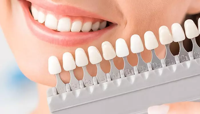 انتخاب رنگ مناسب از مراحل لمینت دندان