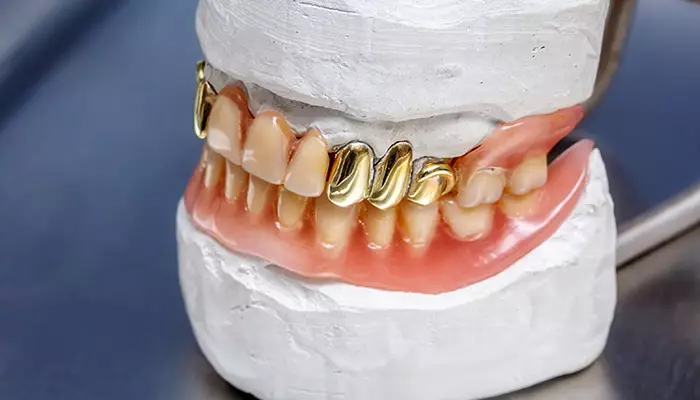 روکش آلیاژ طلا از با سابقه ترین انواع روکش دندان