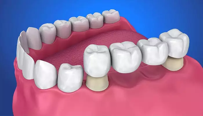 انواع پروتز دندان چیست
