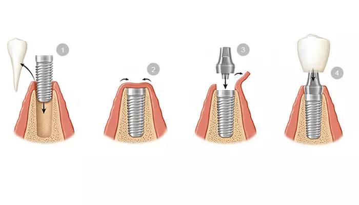 روش اجرای ایمپلنت فوری چیست