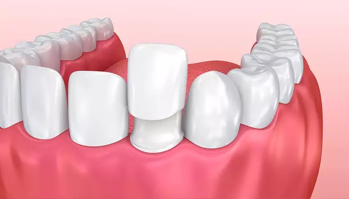 نصب لمینت اولیه