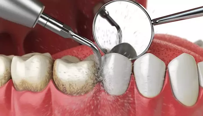 جرم گیری دندان با ابزار اولتراسونیک