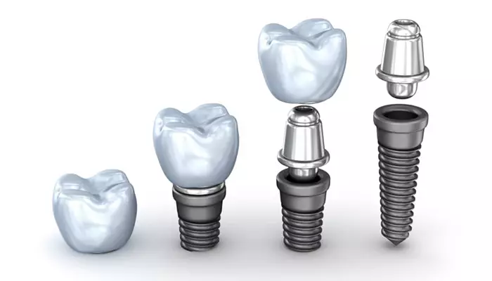 ایمپلنت از چه اجزایی تشکیل میشود