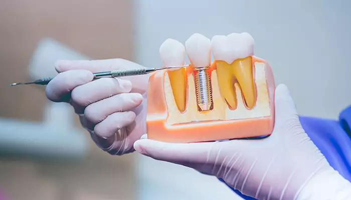 مراقبت های بعد از جراحی ایمپلنت دندان