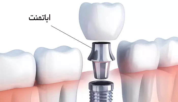 نصب اباتمنت ایمپلنت از مراحل ایمپلنت دندان