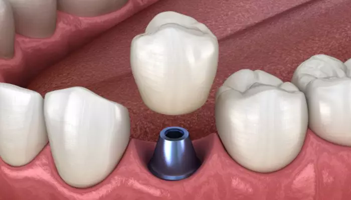 مراحل ایمپلنت دندان