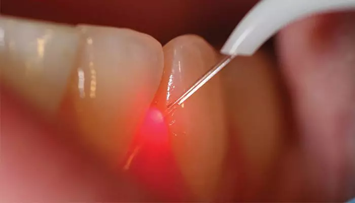 جرم گیری دندان با لیزر