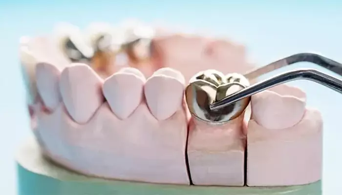 روکش فلزی دندان