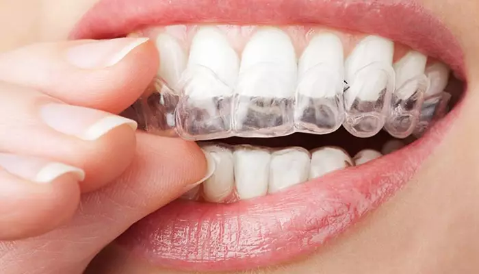 استفاده از نایت گارد برای افزایش ماندگاری لمینت دندان