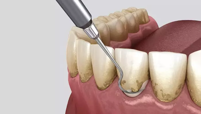جرم گیری دندان به روش سطحی