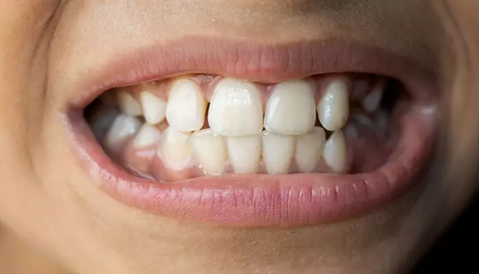 عوارض جرمگیری دندان