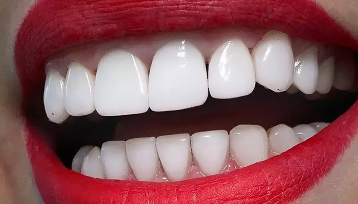 مراحل انجام لمینت دندان