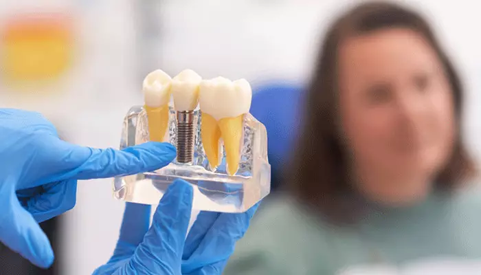 ایمپلنت فوری برای چه کسانی مناسب است