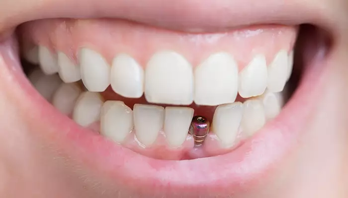 ایمپلنت دندان برای چه کسانی مناسب است