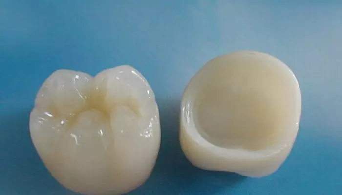 روکش دندان زیرکونیا